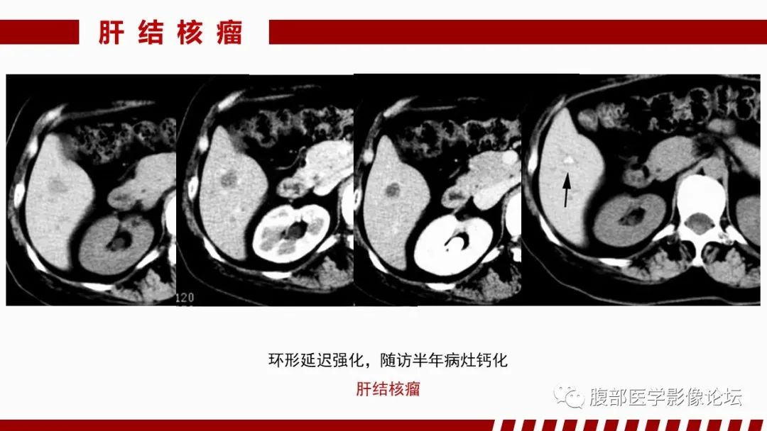 影像PPT - 【PPT】肝脏感染性疾病的多模态影像诊断及鉴别-35