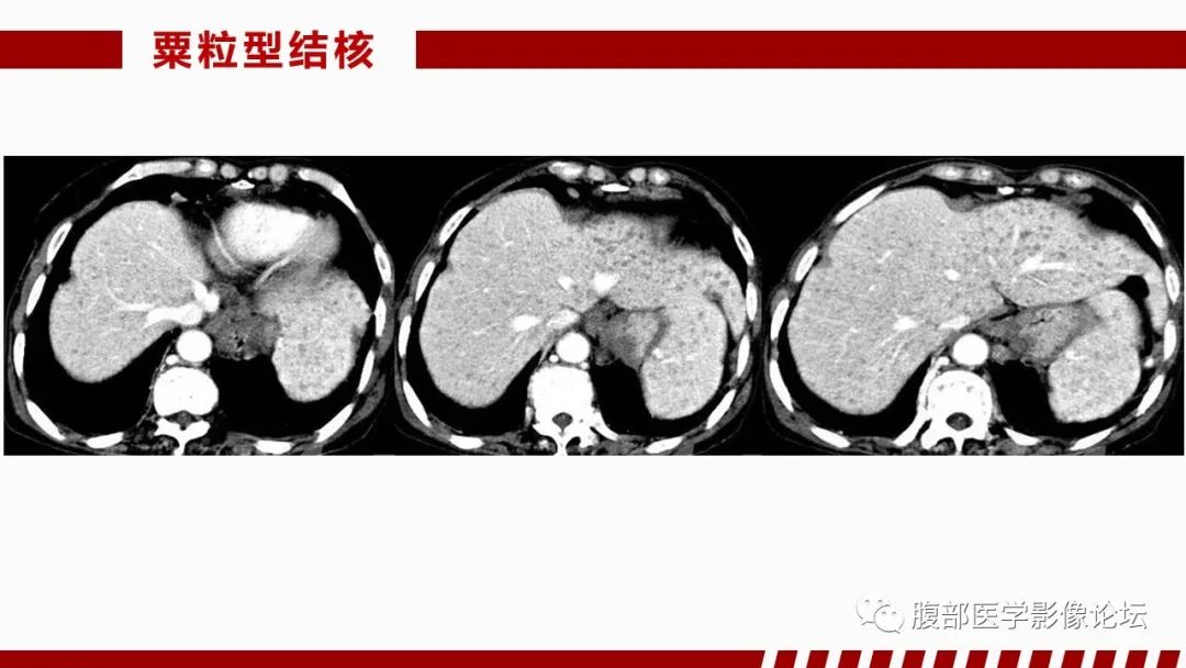 影像PPT - 【PPT】肝脏感染性疾病的多模态影像诊断及鉴别-33