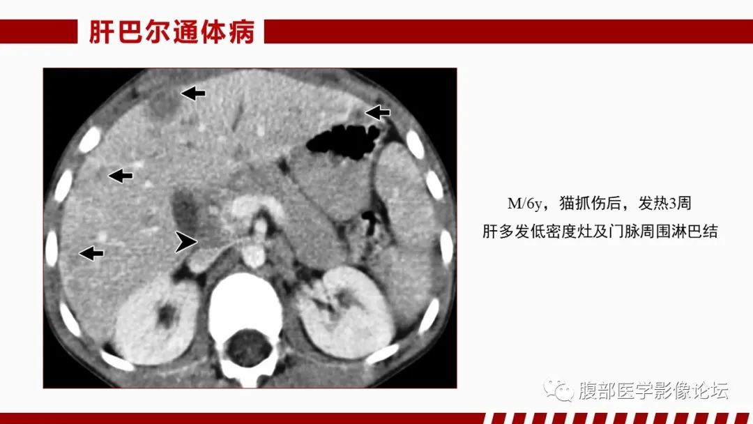 影像PPT - 【PPT】肝脏感染性疾病的多模态影像诊断及鉴别-38