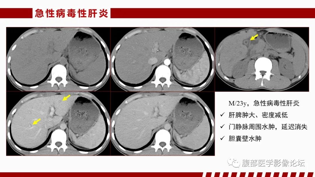 影像PPT - 【PPT】肝脏感染性疾病的多模态影像诊断及鉴别-42