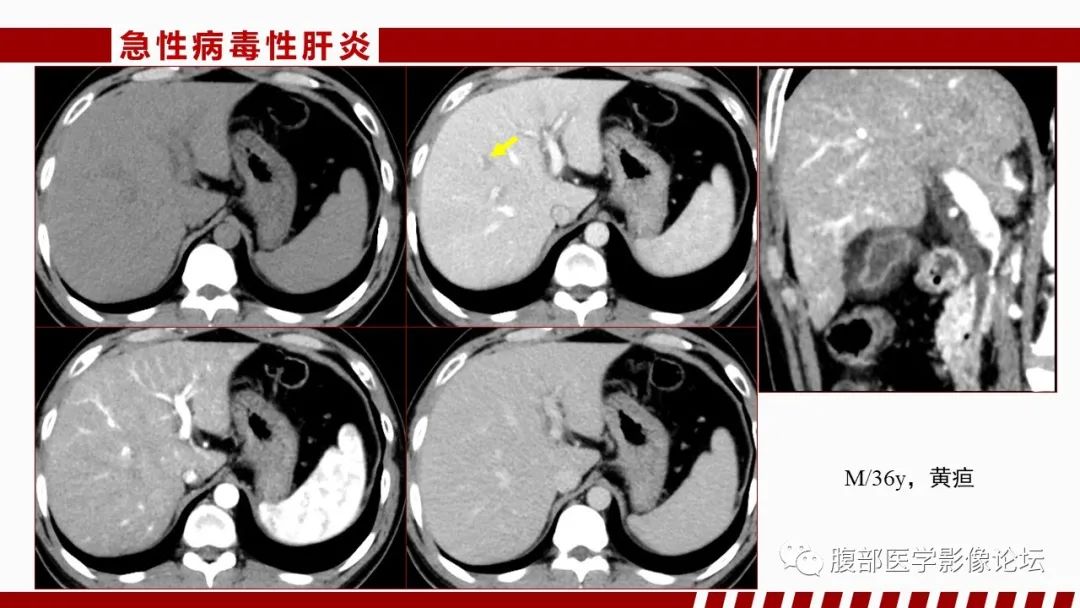 影像PPT - 【PPT】肝脏感染性疾病的多模态影像诊断及鉴别-43