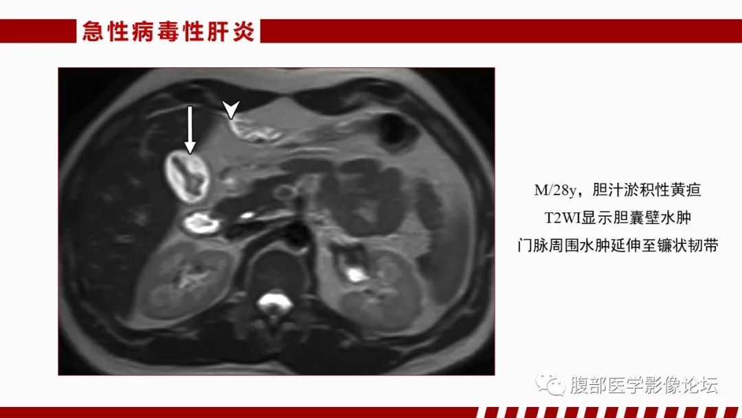 影像PPT - 【PPT】肝脏感染性疾病的多模态影像诊断及鉴别-44