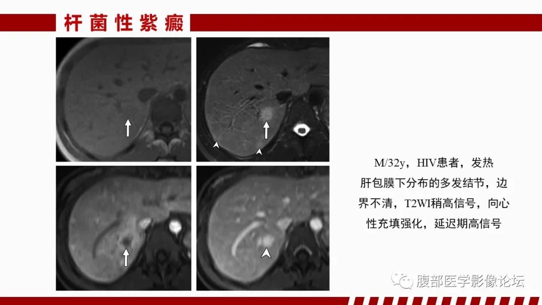 影像PPT - 【PPT】肝脏感染性疾病的多模态影像诊断及鉴别-39