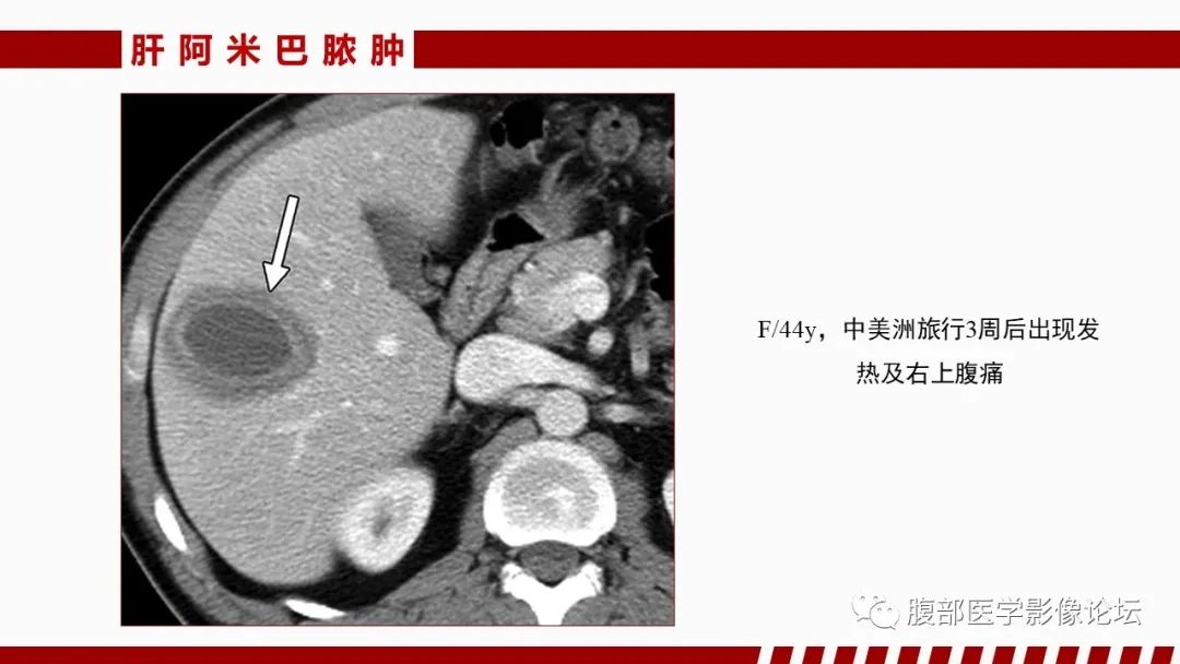 影像PPT - 【PPT】肝脏感染性疾病的多模态影像诊断及鉴别-47