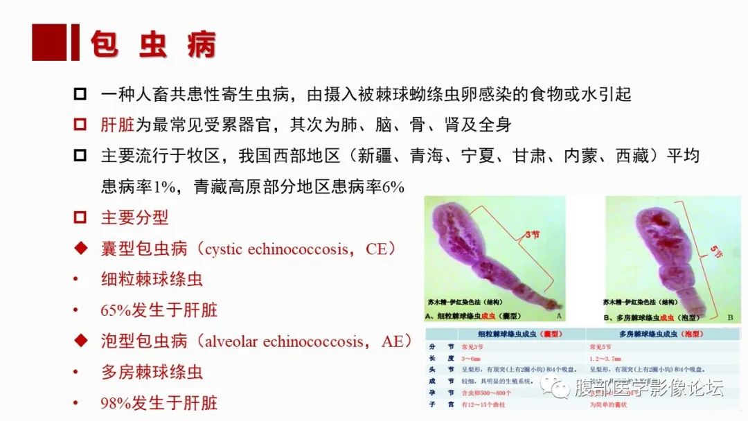 影像PPT - 【PPT】肝脏感染性疾病的多模态影像诊断及鉴别-48