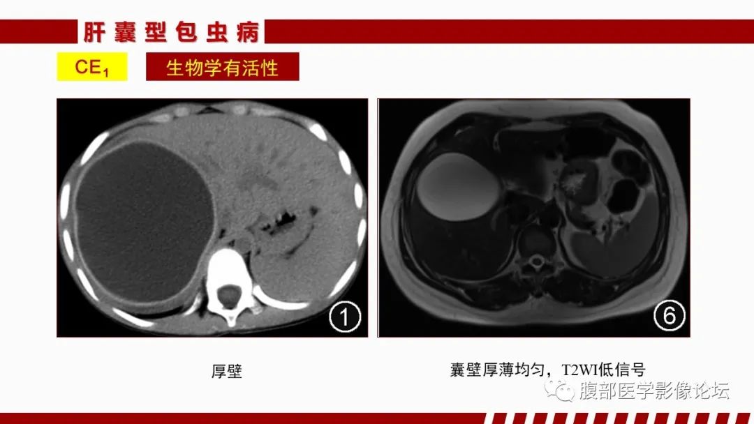 影像PPT - 【PPT】肝脏感染性疾病的多模态影像诊断及鉴别-53
