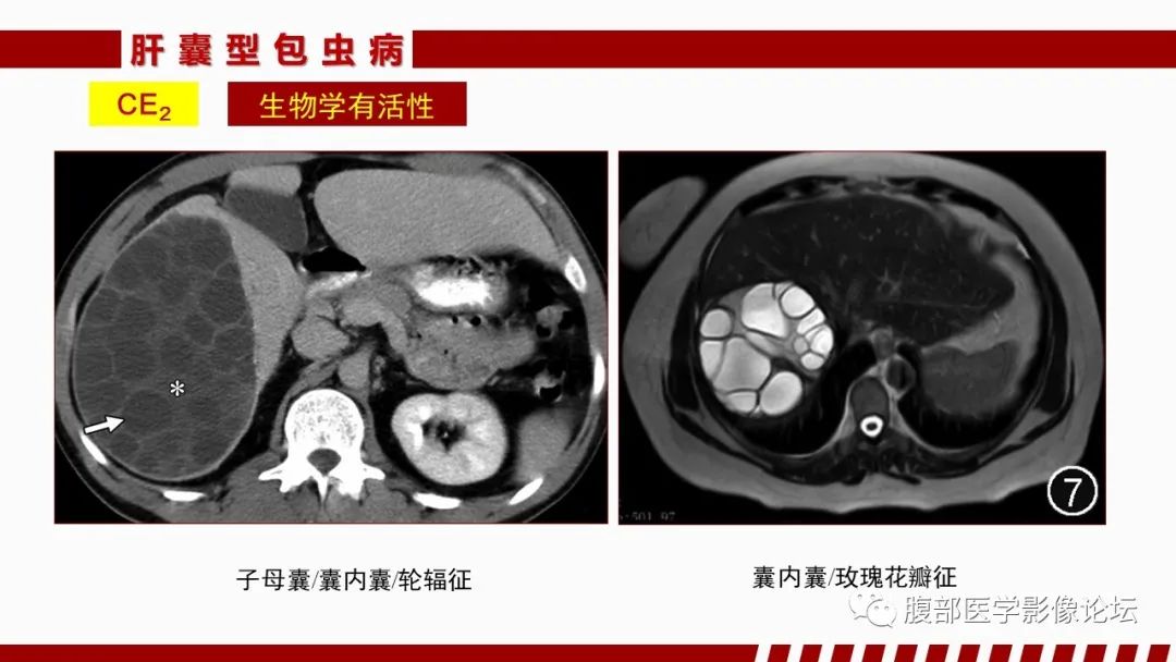 影像PPT - 【PPT】肝脏感染性疾病的多模态影像诊断及鉴别-54