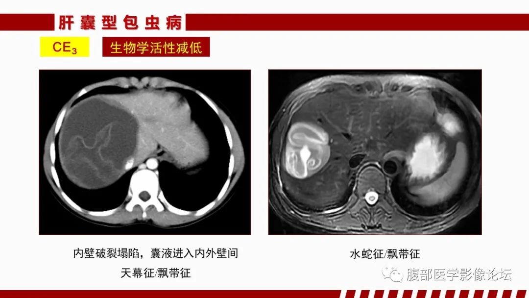 影像PPT - 【PPT】肝脏感染性疾病的多模态影像诊断及鉴别-55