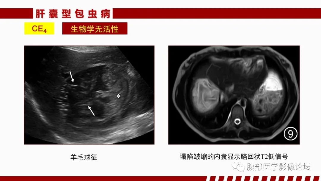 影像PPT - 【PPT】肝脏感染性疾病的多模态影像诊断及鉴别-56