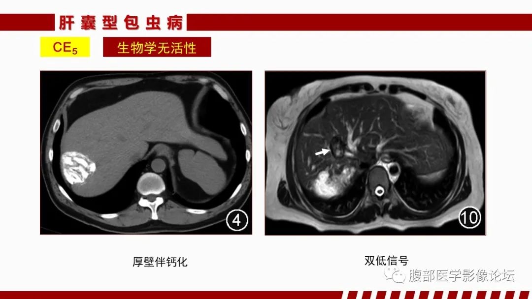 影像PPT - 【PPT】肝脏感染性疾病的多模态影像诊断及鉴别-58