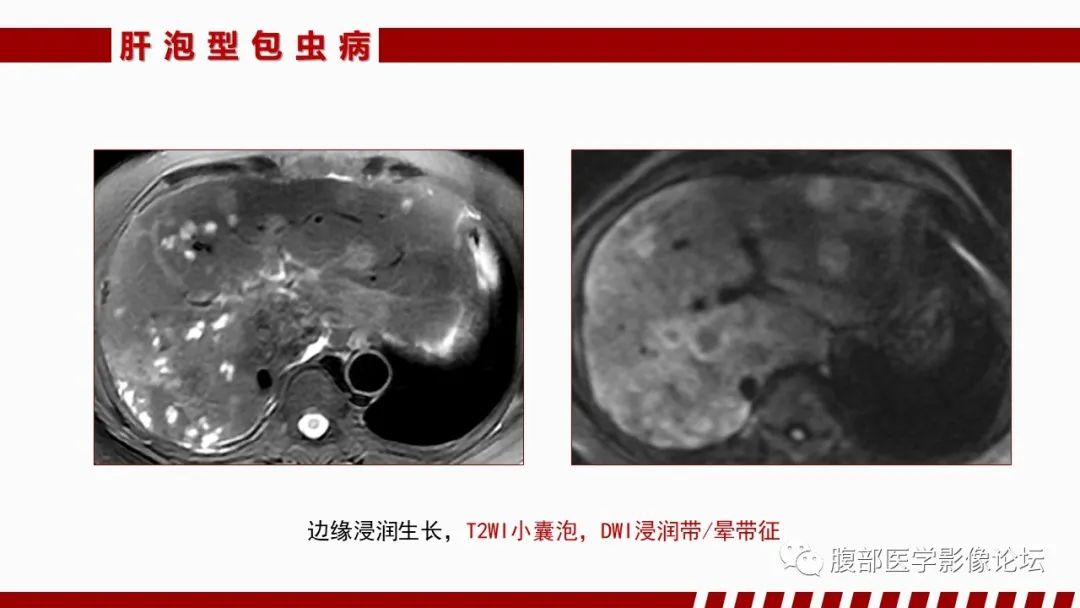 影像PPT - 【PPT】肝脏感染性疾病的多模态影像诊断及鉴别-64