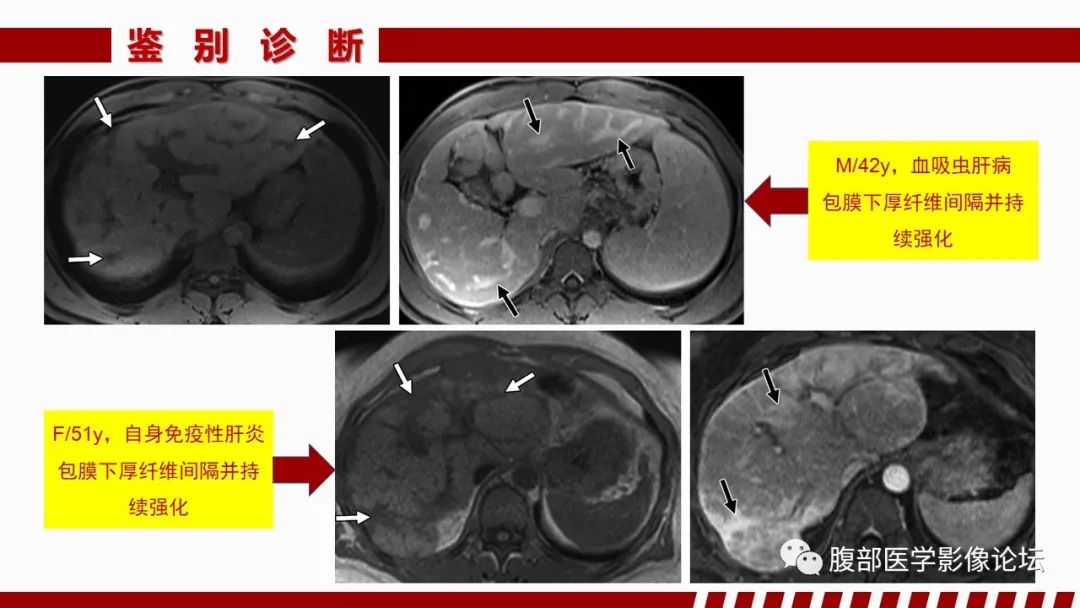影像PPT - 【PPT】肝脏感染性疾病的多模态影像诊断及鉴别-73