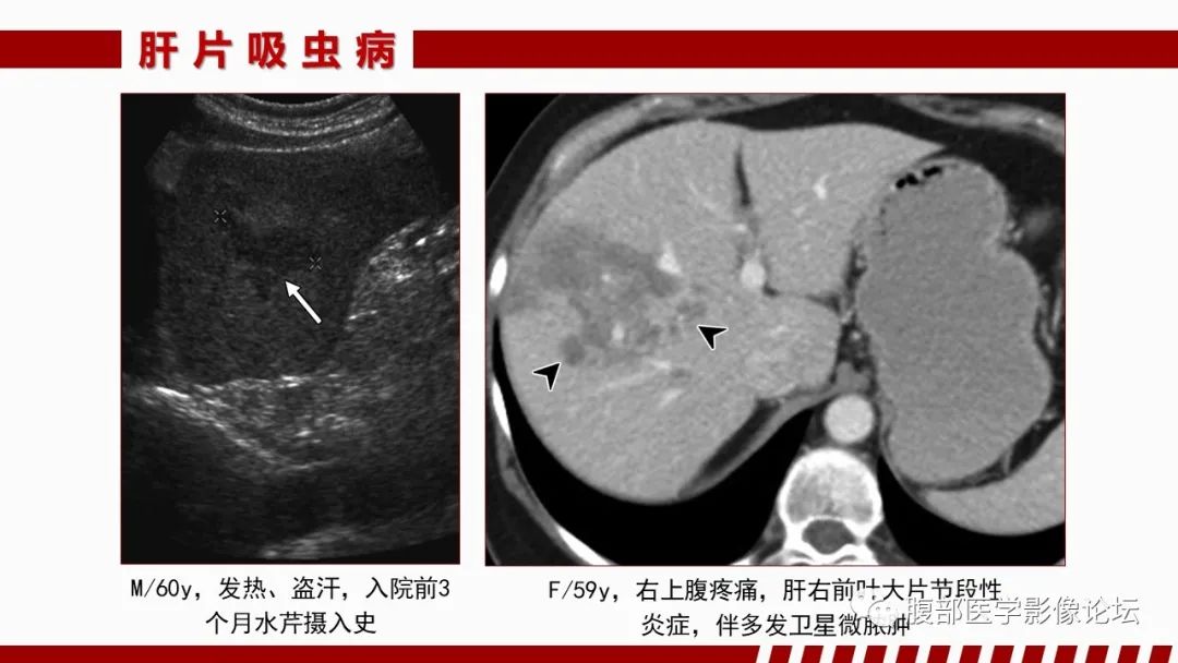 影像PPT - 【PPT】肝脏感染性疾病的多模态影像诊断及鉴别-68