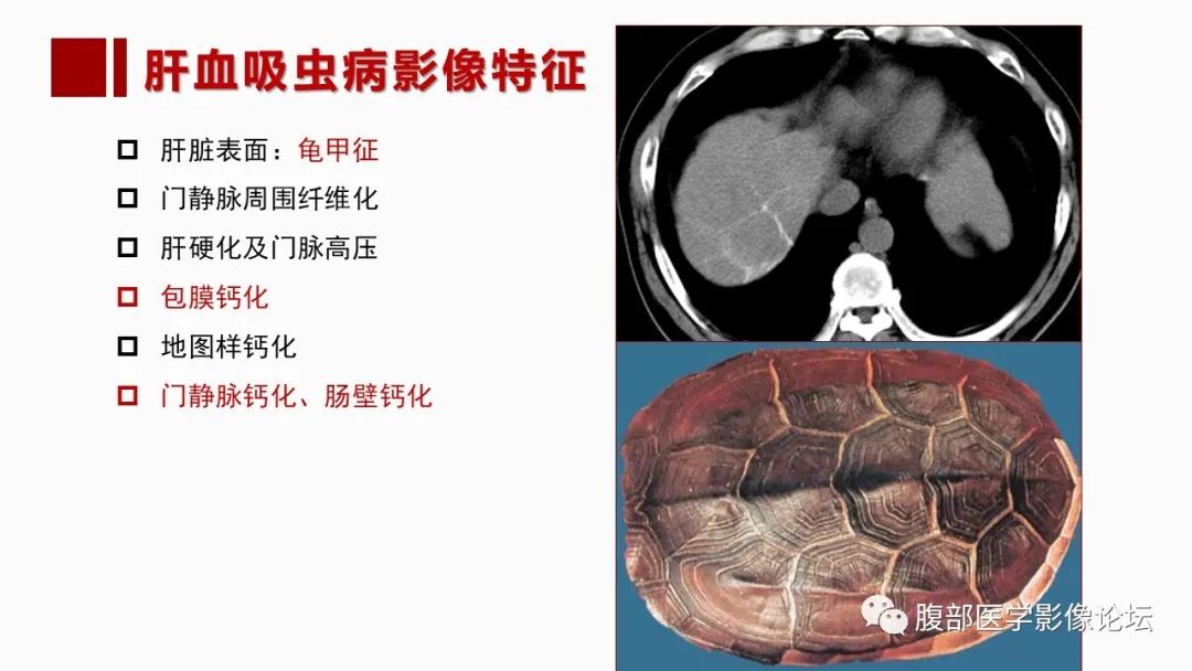 影像PPT - 【PPT】肝脏感染性疾病的多模态影像诊断及鉴别-71