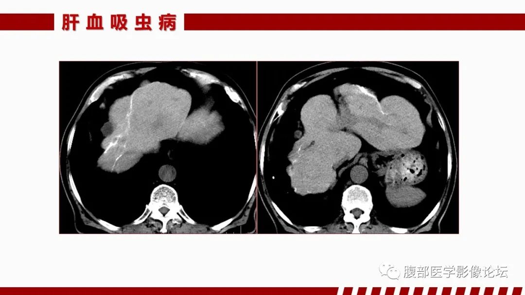 影像PPT - 【PPT】肝脏感染性疾病的多模态影像诊断及鉴别-72