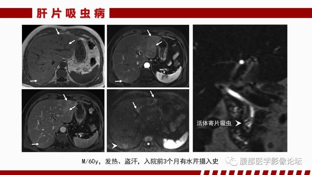 影像PPT - 【PPT】肝脏感染性疾病的多模态影像诊断及鉴别-69