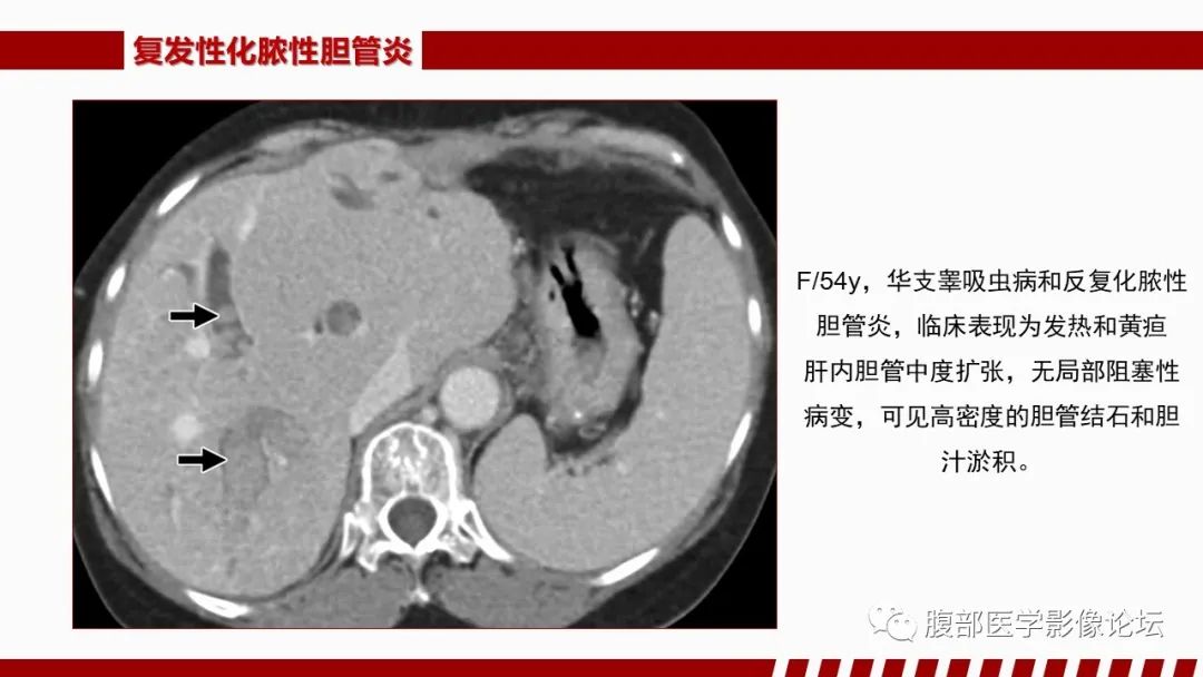 影像PPT - 【PPT】肝脏感染性疾病的多模态影像诊断及鉴别-75