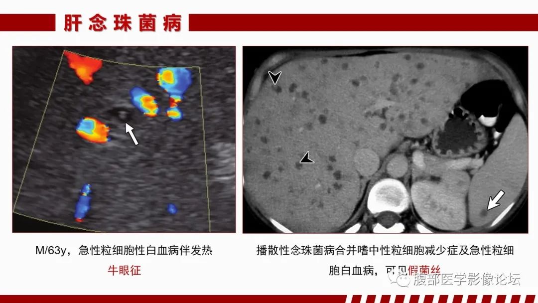 影像PPT - 【PPT】肝脏感染性疾病的多模态影像诊断及鉴别-78