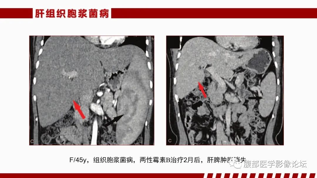 影像PPT - 【PPT】肝脏感染性疾病的多模态影像诊断及鉴别-82