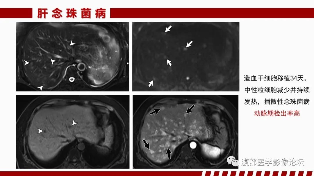 影像PPT - 【PPT】肝脏感染性疾病的多模态影像诊断及鉴别-79
