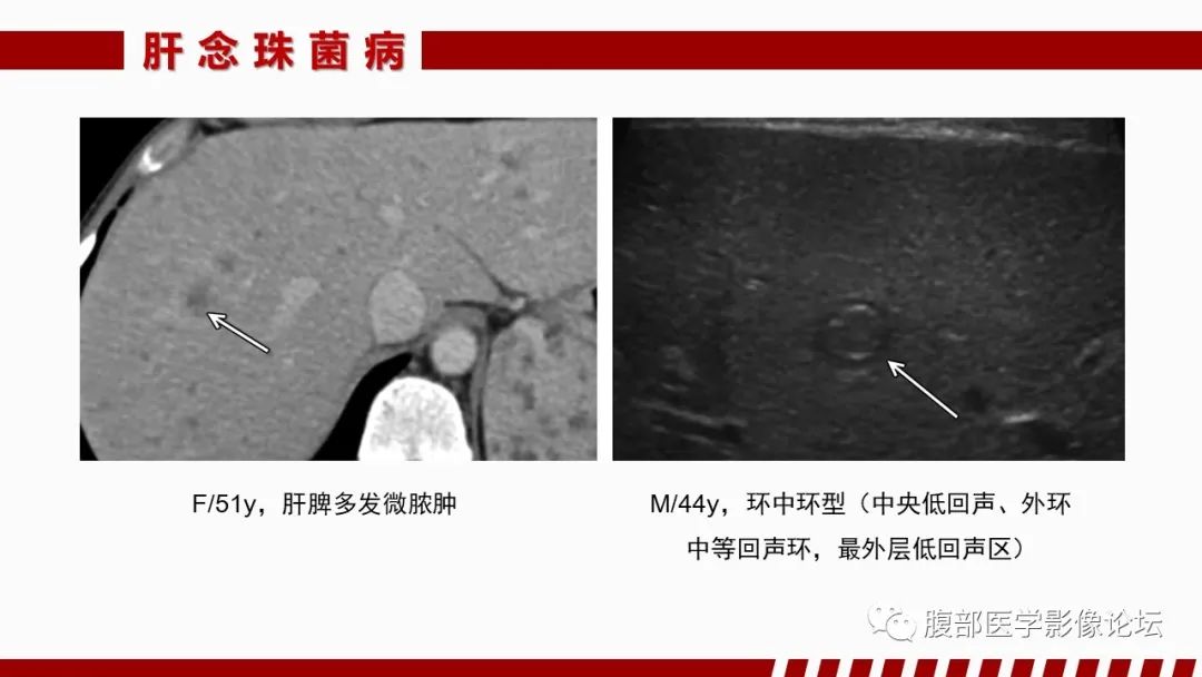 影像PPT - 【PPT】肝脏感染性疾病的多模态影像诊断及鉴别-80