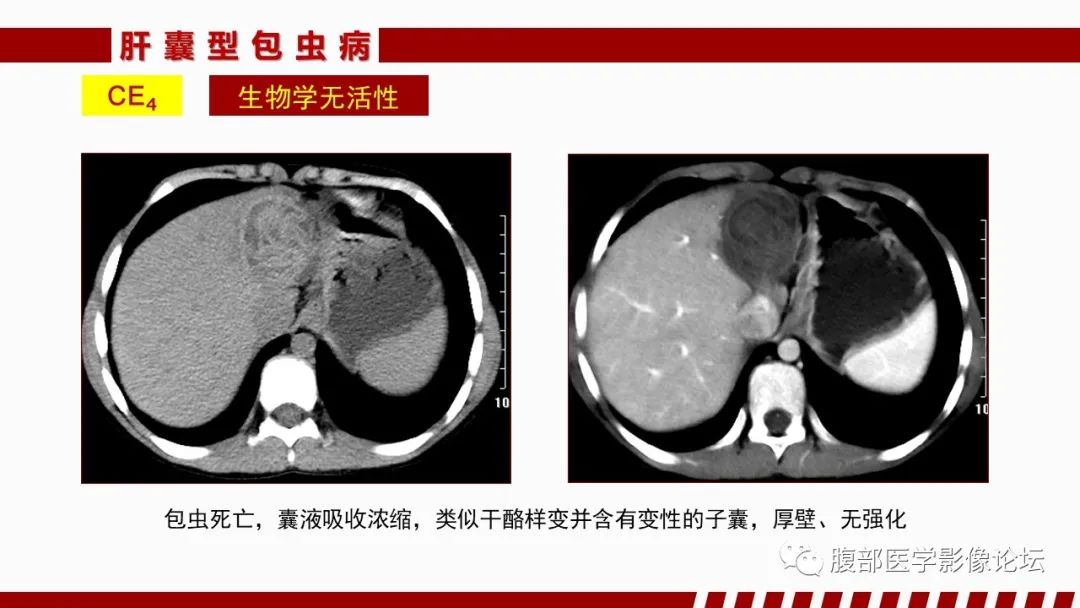 影像PPT - 【PPT】肝脏感染性疾病的多模态影像诊断及鉴别-57