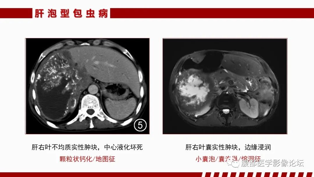 影像PPT - 【PPT】肝脏感染性疾病的多模态影像诊断及鉴别-3