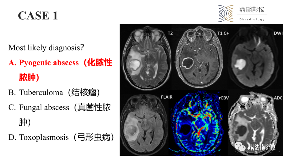 影像PPT - 【PPT】脑内感染性环形强化病变病因诊断的MRI线索-9