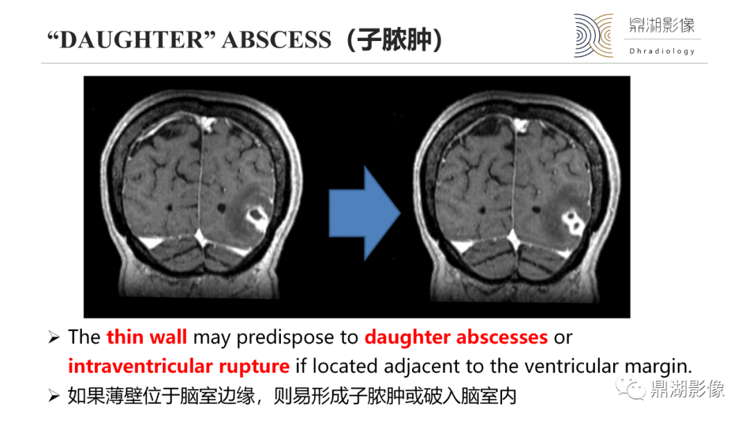 影像PPT - 【PPT】脑内感染性环形强化病变病因诊断的MRI线索-14