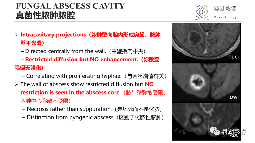 影像PPT - 【PPT】脑内感染性环形强化病变病因诊断的MRI线索-19