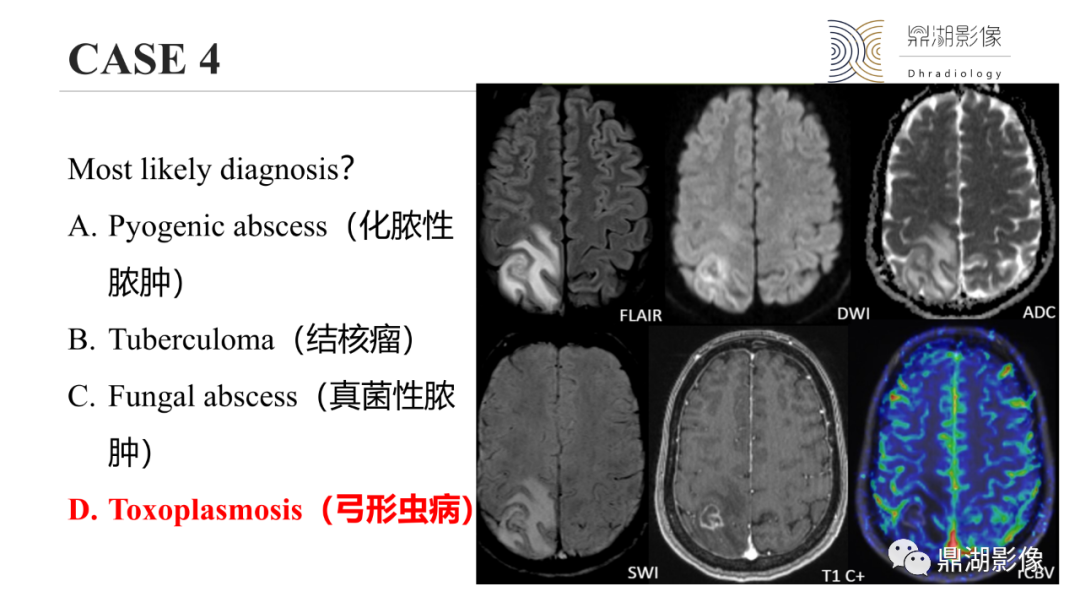 影像PPT - 【PPT】脑内感染性环形强化病变病因诊断的MRI线索-26