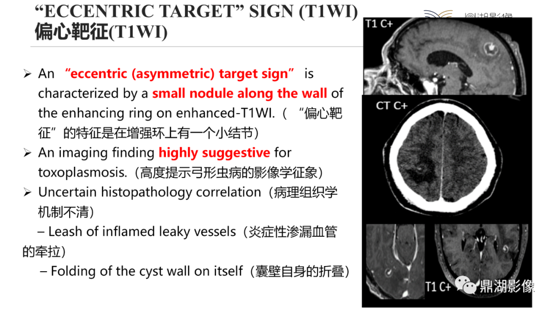 影像PPT - 【PPT】脑内感染性环形强化病变病因诊断的MRI线索-30