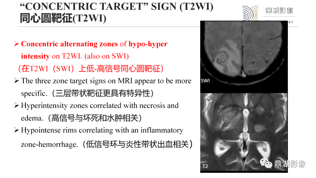 影像PPT - 【PPT】脑内感染性环形强化病变病因诊断的MRI线索-29