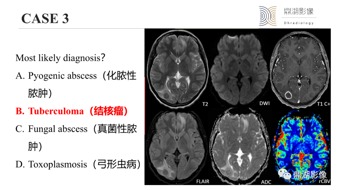 影像PPT - 【PPT】脑内感染性环形强化病变病因诊断的MRI线索-21