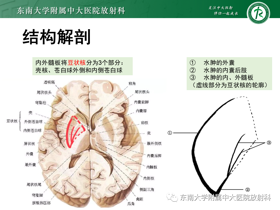 影像PPT - 【PPT】豆状核叉征(LFS)—透析性脑病-6 影像PPT - 【PPT】豆状核叉征(LFS)—透析性脑病-6