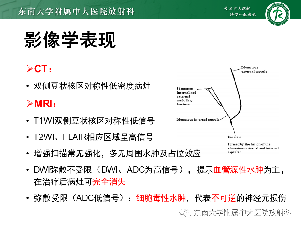 影像PPT - 【PPT】豆状核叉征(LFS)—透析性脑病-7 影像PPT - 【PPT】豆状核叉征(LFS)—透析性脑病-7