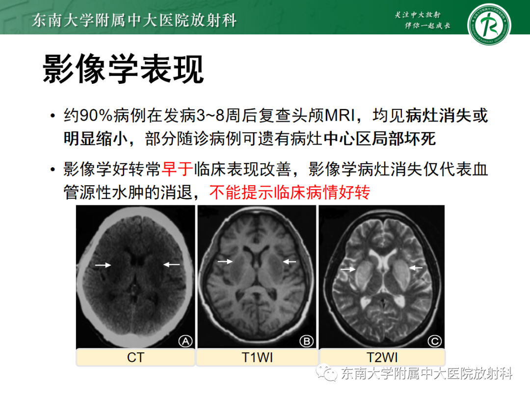 影像PPT - 【PPT】豆状核叉征(LFS)—透析性脑病-8 影像PPT - 【PPT】豆状核叉征(LFS)—透析性脑病-8