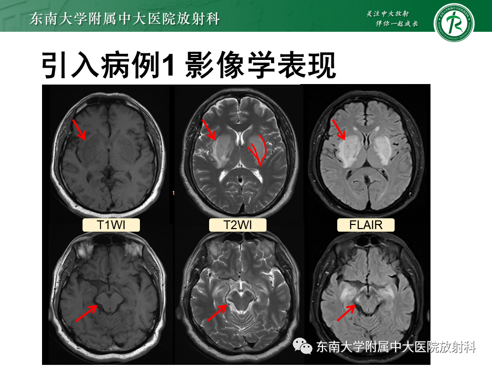 影像PPT - 【PPT】豆状核叉征(LFS)—透析性脑病-12 影像PPT - 【PPT】豆状核叉征(LFS)—透析性脑病-12