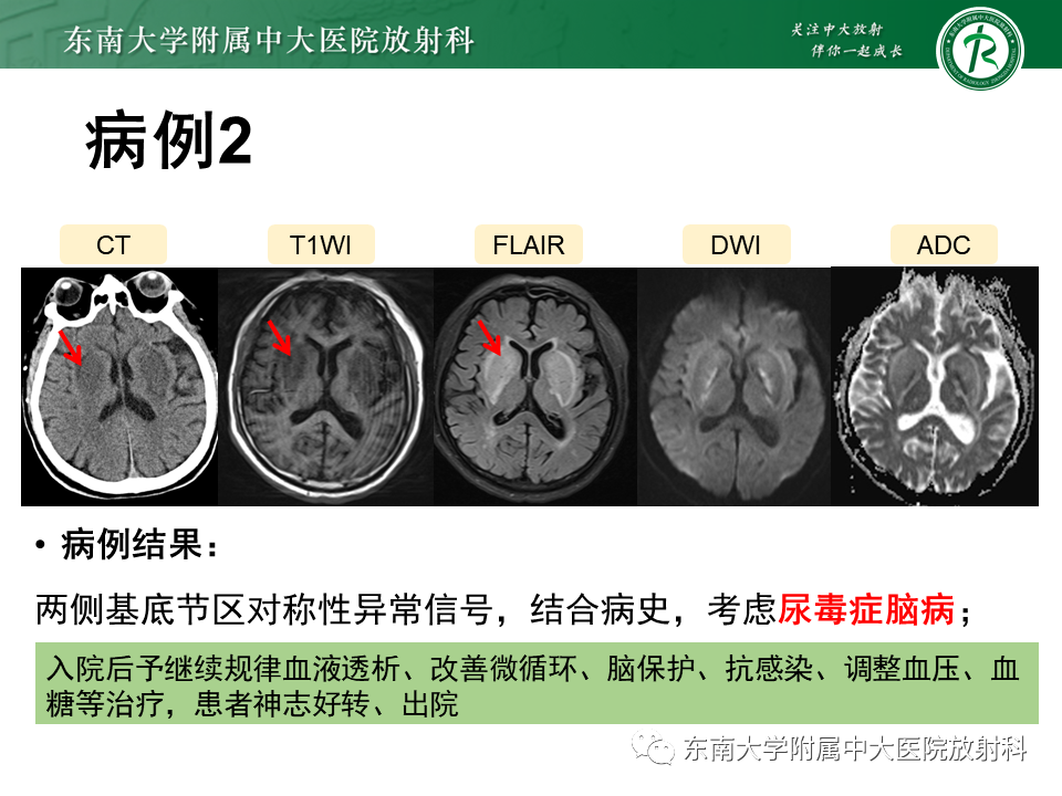 影像PPT - 【PPT】豆状核叉征(LFS)—透析性脑病-18 影像PPT - 【PPT】豆状核叉征(LFS)—透析性脑病-18