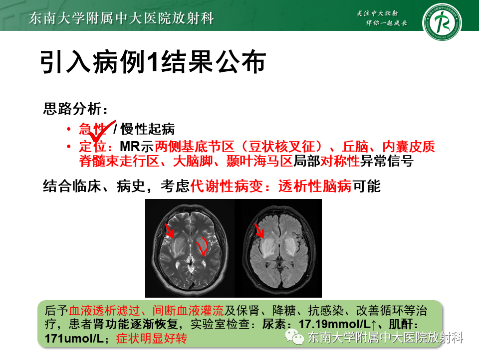 影像PPT - 【PPT】豆状核叉征(LFS)—透析性脑病-3 影像PPT - 【PPT】豆状核叉征(LFS)—透析性脑病-3