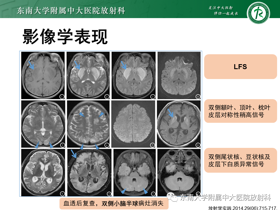 影像PPT - 【PPT】豆状核叉征(LFS)—透析性脑病-16 影像PPT - 【PPT】豆状核叉征(LFS)—透析性脑病-16