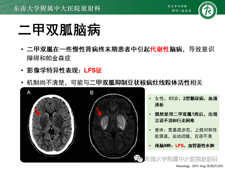 影像PPT - 【PPT】豆状核叉征(LFS)—透析性脑病-20 影像PPT - 【PPT】豆状核叉征(LFS)—透析性脑病-20
