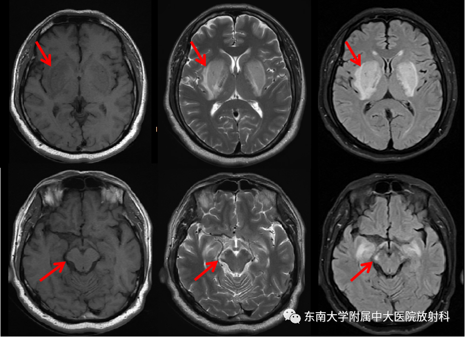 影像PPT - 【PPT】豆状核叉征(LFS)—透析性脑病-1 影像PPT - 【PPT】豆状核叉征(LFS)—透析性脑病-1