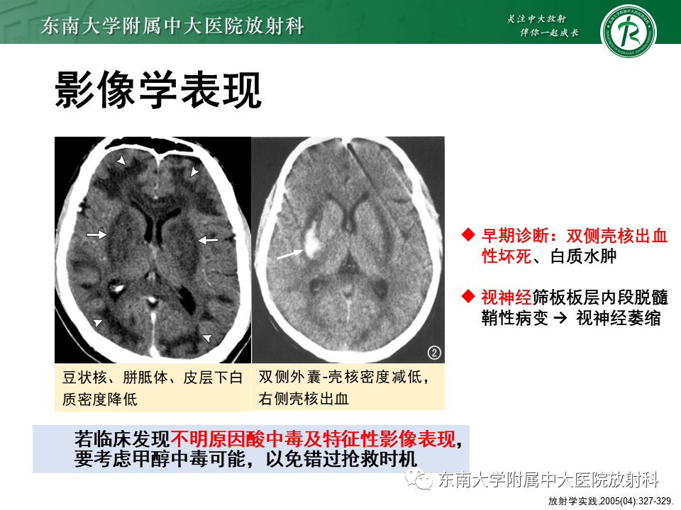 影像PPT - 【PPT】豆状核叉征(LFS)—透析性脑病-22 影像PPT - 【PPT】豆状核叉征(LFS)—透析性脑病-22