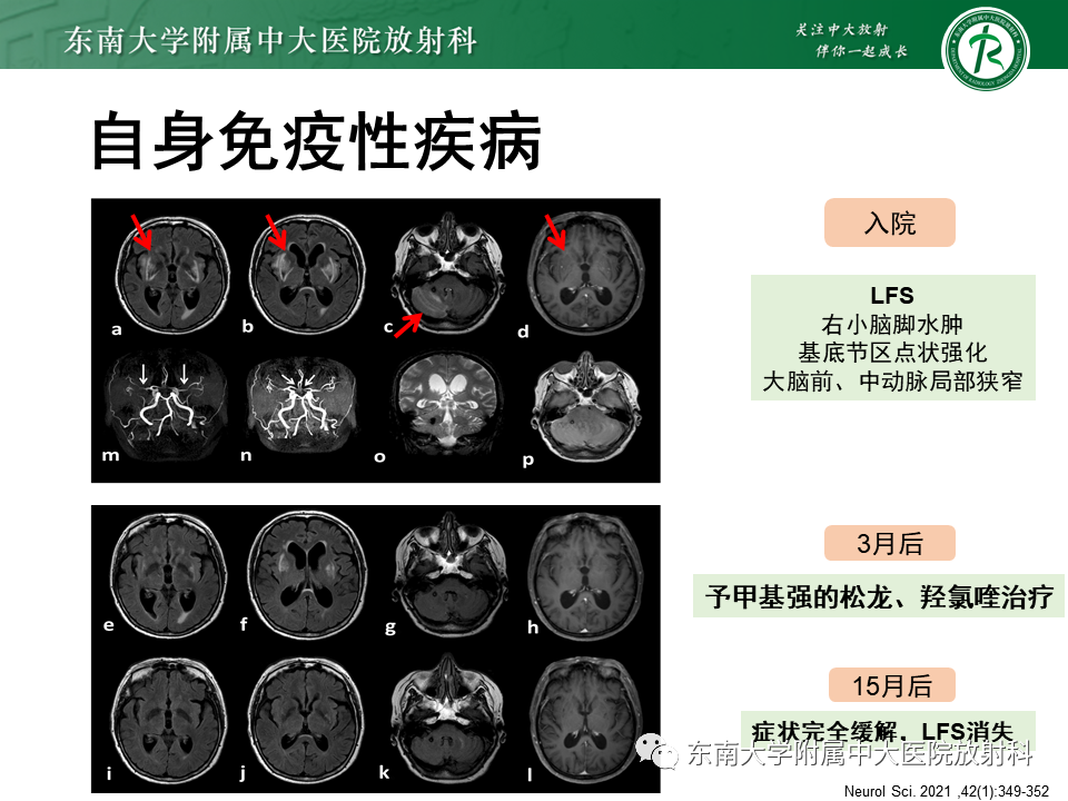 影像PPT - 【PPT】豆状核叉征(LFS)—透析性脑病-27 影像PPT - 【PPT】豆状核叉征(LFS)—透析性脑病-27