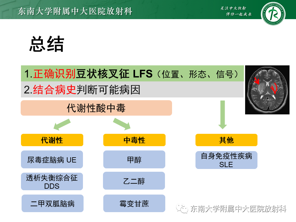影像PPT - 【PPT】豆状核叉征(LFS)—透析性脑病-29 影像PPT - 【PPT】豆状核叉征(LFS)—透析性脑病-29