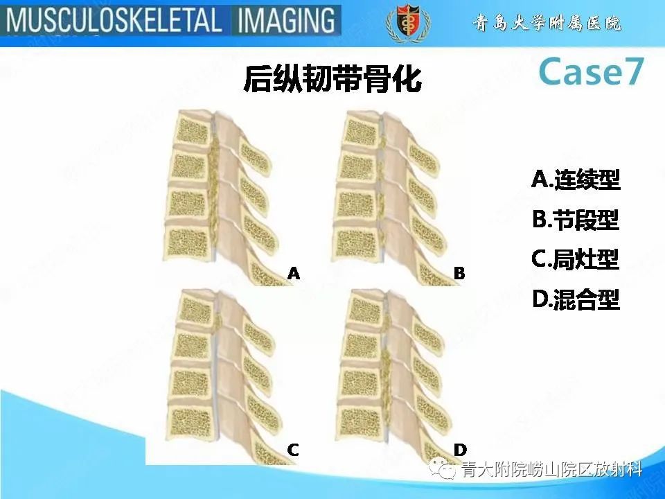 影像PPT - 【PPT】椎体缺血性坏死-10