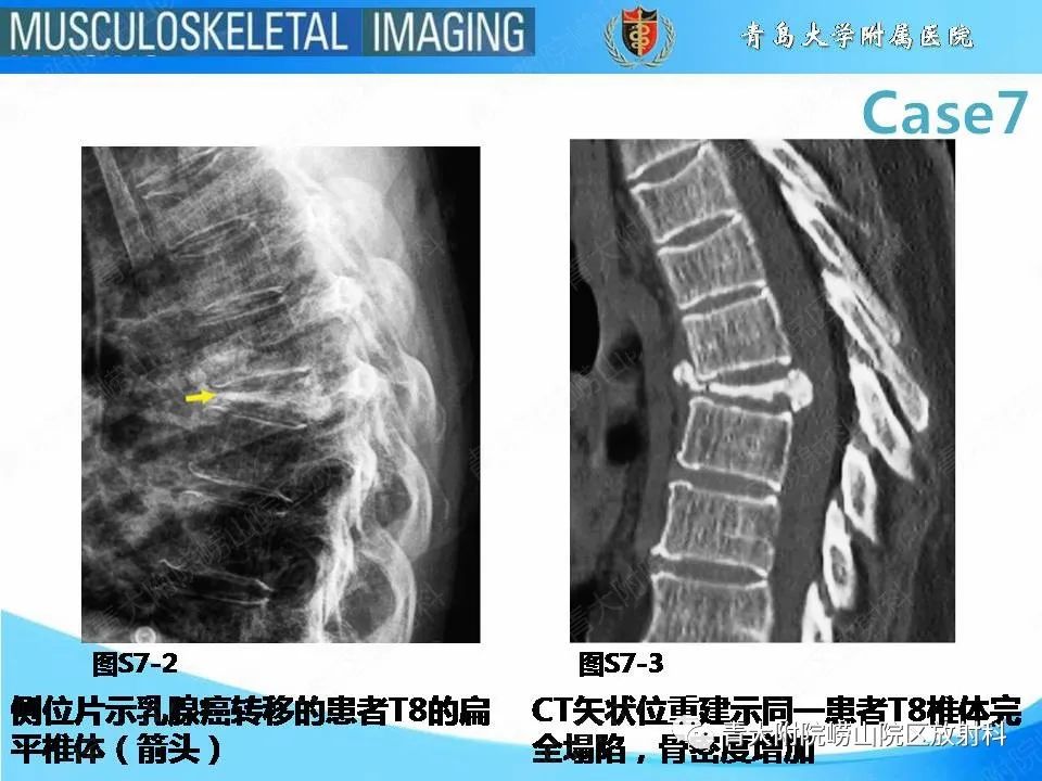 影像PPT - 【PPT】椎体缺血性坏死-5