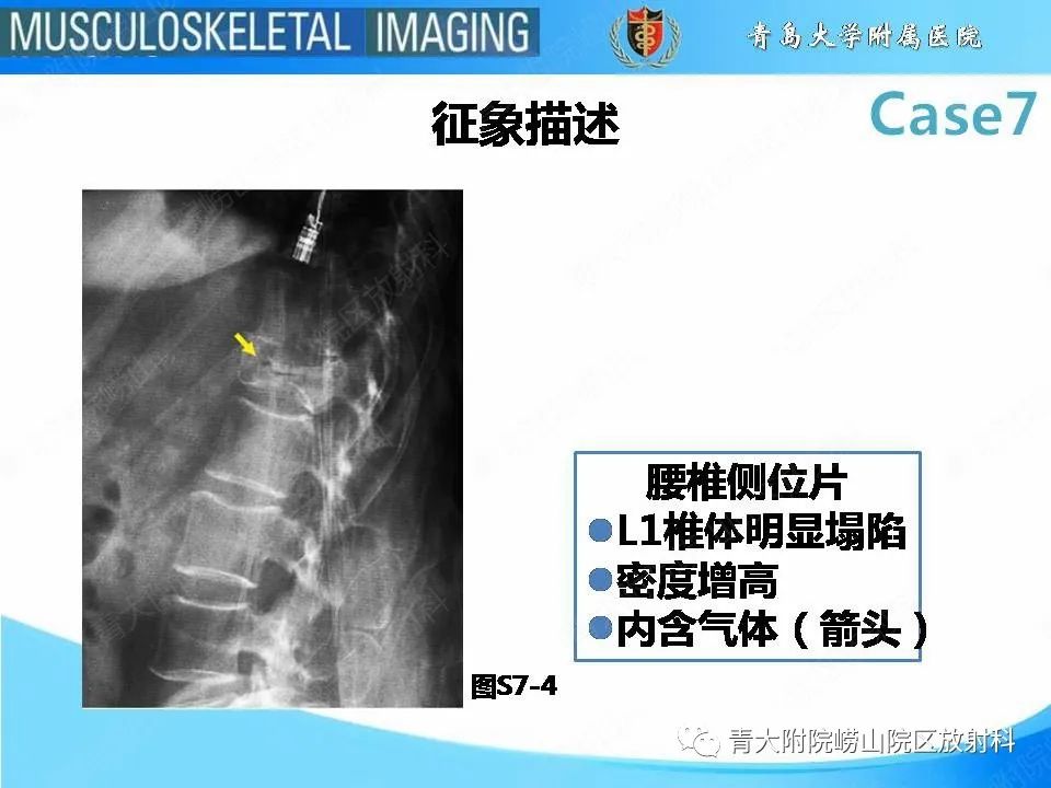 影像PPT - 【PPT】椎体缺血性坏死-16