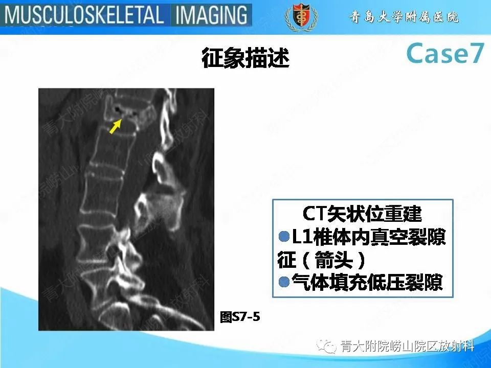 影像PPT - 【PPT】椎体缺血性坏死-17